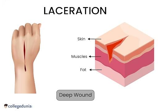 laceration wound