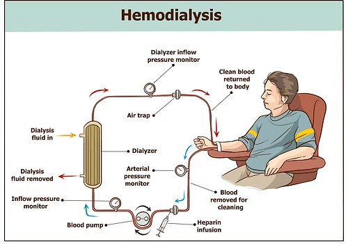 Hemodialysis Function Types And Advantages Of Dialysis 6502