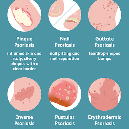 Psoriasis: Types, Causes, Symptoms & Treatment