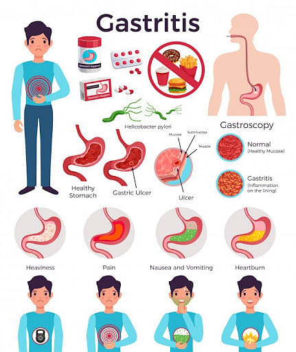 Gastric Meaning Causessymptoms And Diagnosis