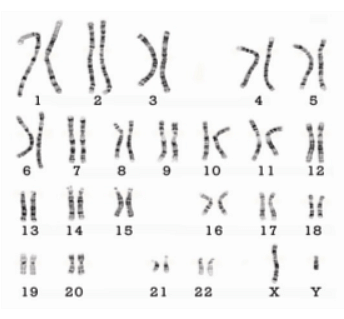 dwarfism karyotype