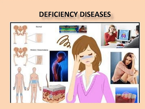 Deficiency Diseases Definition Examples Types And Explanation 2283