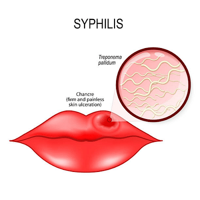 Syphilis: Meaning, Stages, Causes, Symptoms & Treatment