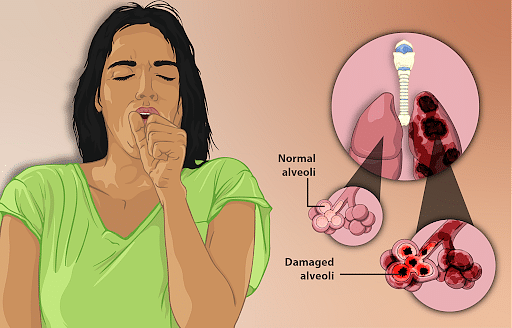 Emphysema Causes Symptoms Diagnostic Procedure And Prevention