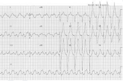 Which of the following drugs is responsible for the ECG finding?