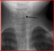 The radiograph-respiratory distress and biphasic stridor