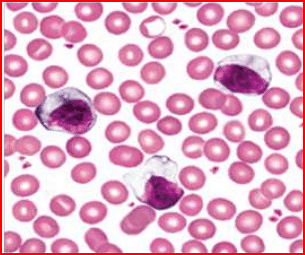 peripheral smear-AML with t(15;17)