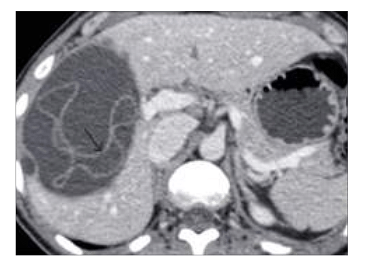 abdominal pain