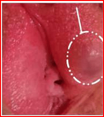 aA tender swelling with redness on the labia