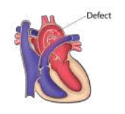 A defect in which of the following aortic arches causes the defect shown in the image?