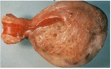 30 year old woman with complaint of dysmenorrhoea, dyspareunia with chronic pelvic pain undergoes hysterectomy. From the cut section of hysterectomy specimen below identify the condition.